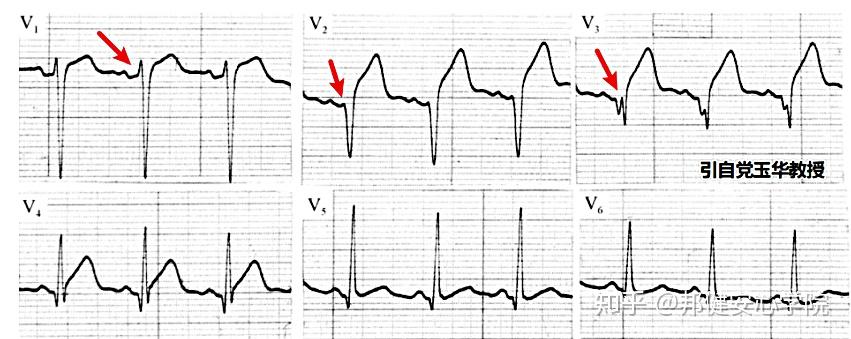 胸前导联r波递增不良有哪几种表现