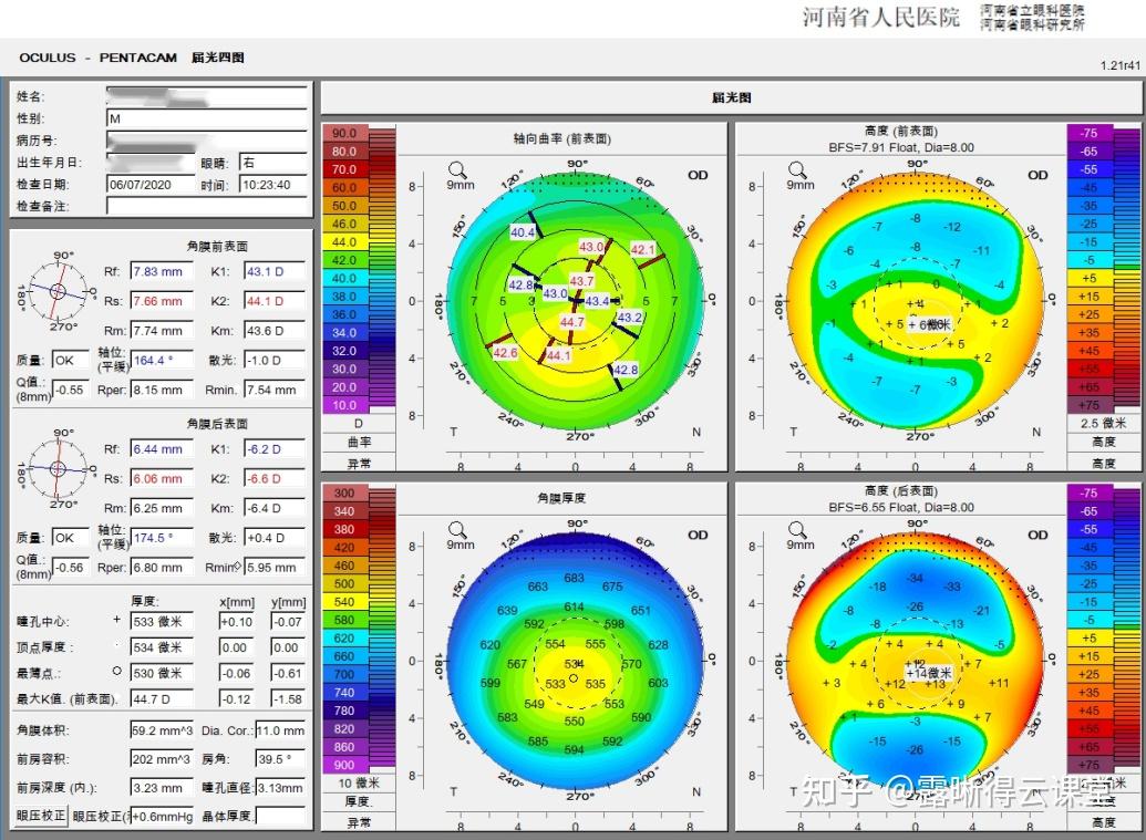圆锥角膜的RGP验配及RGP临床效果分析（文字版） - 知乎