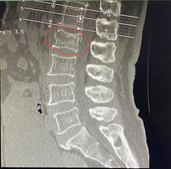 朱医生的患者故事 腰椎骨折