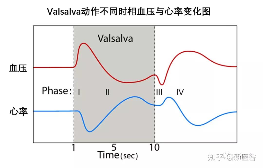 改良valsalva动作图解图片