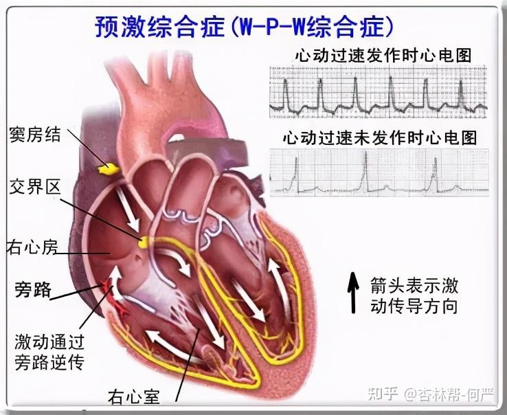 射频消融术原理示意图图片