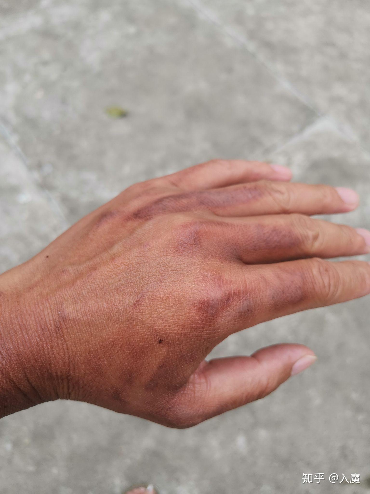 求:被火烧伤后如何处理?