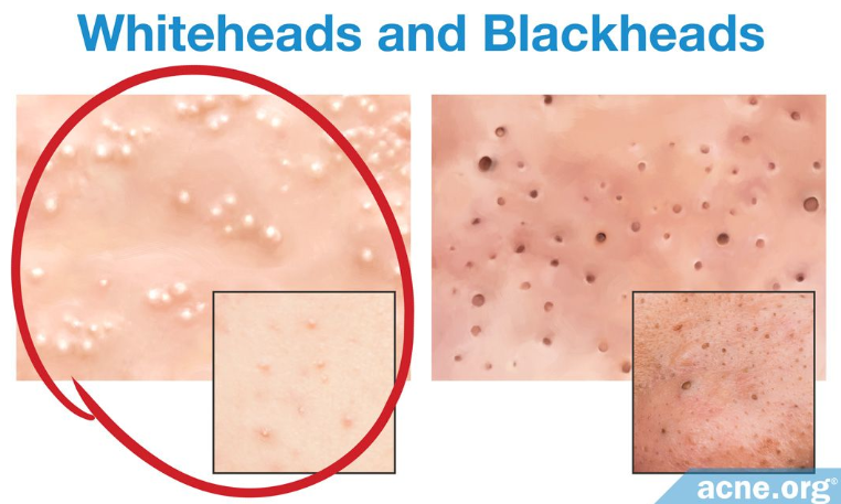 什么是黑头闭口 v2-19f8d7d5ac847a77357f734389253873_1440w.jpg?source=172ae18b