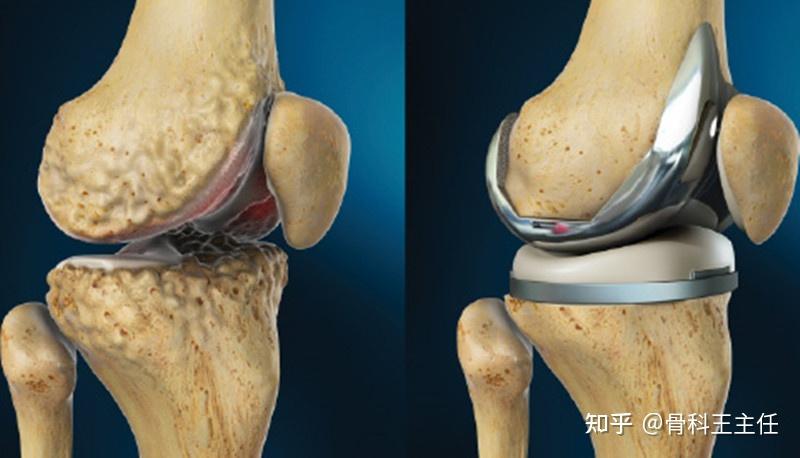 膝關節炎伴有半月板撕裂半月板手術還是關節置換該選哪一個