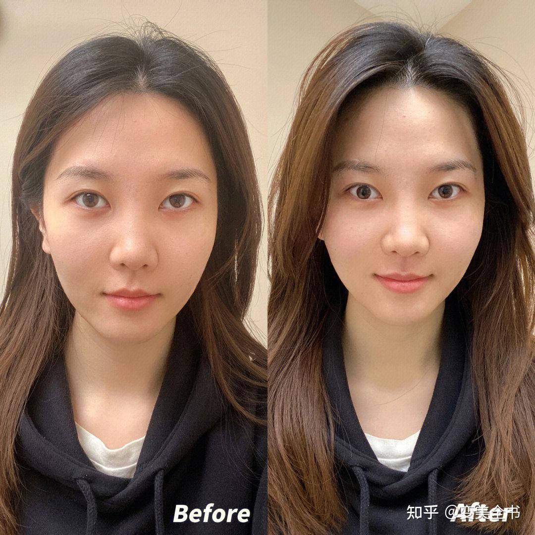 超声炮抗衰和热玛吉,fotona4d对比哪个效果会更好呢?维持时间怎么样?