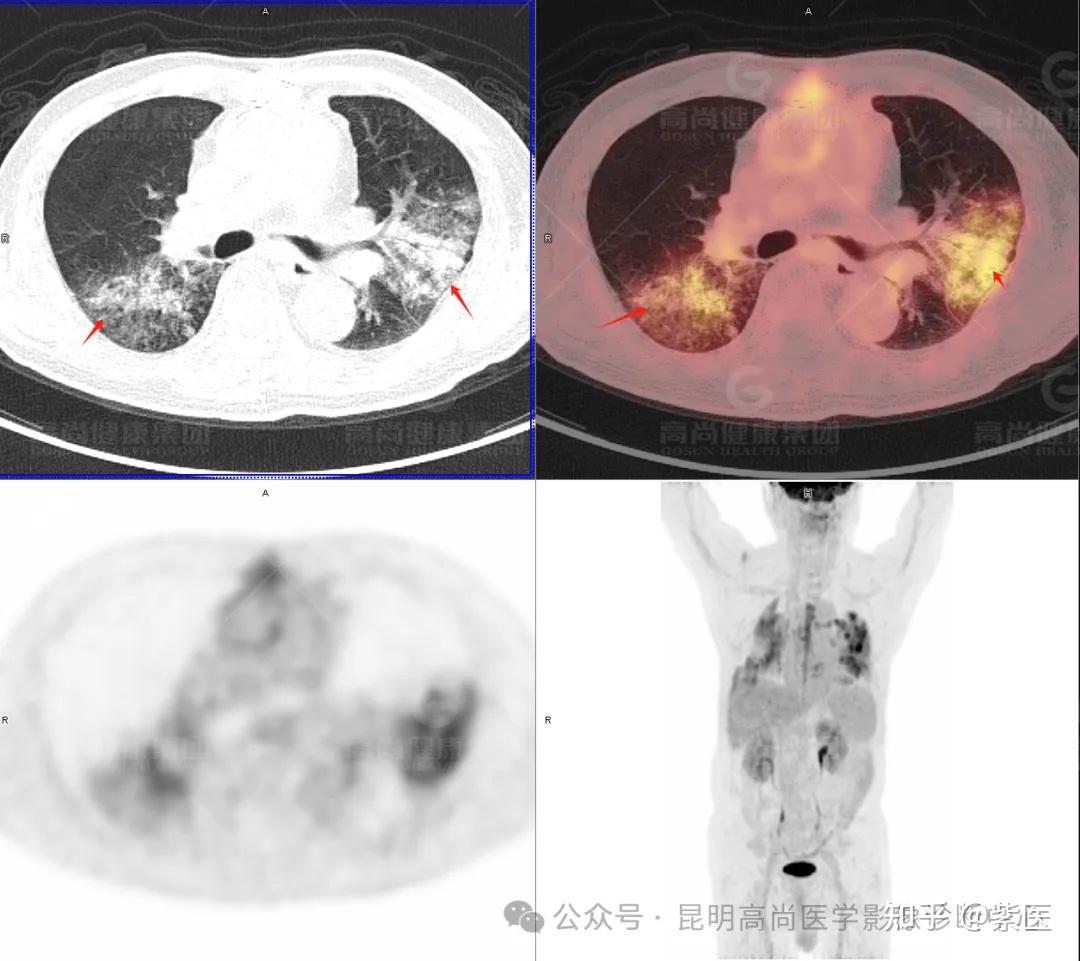 PET/CT诊断肺炎型肺癌 - 知乎
