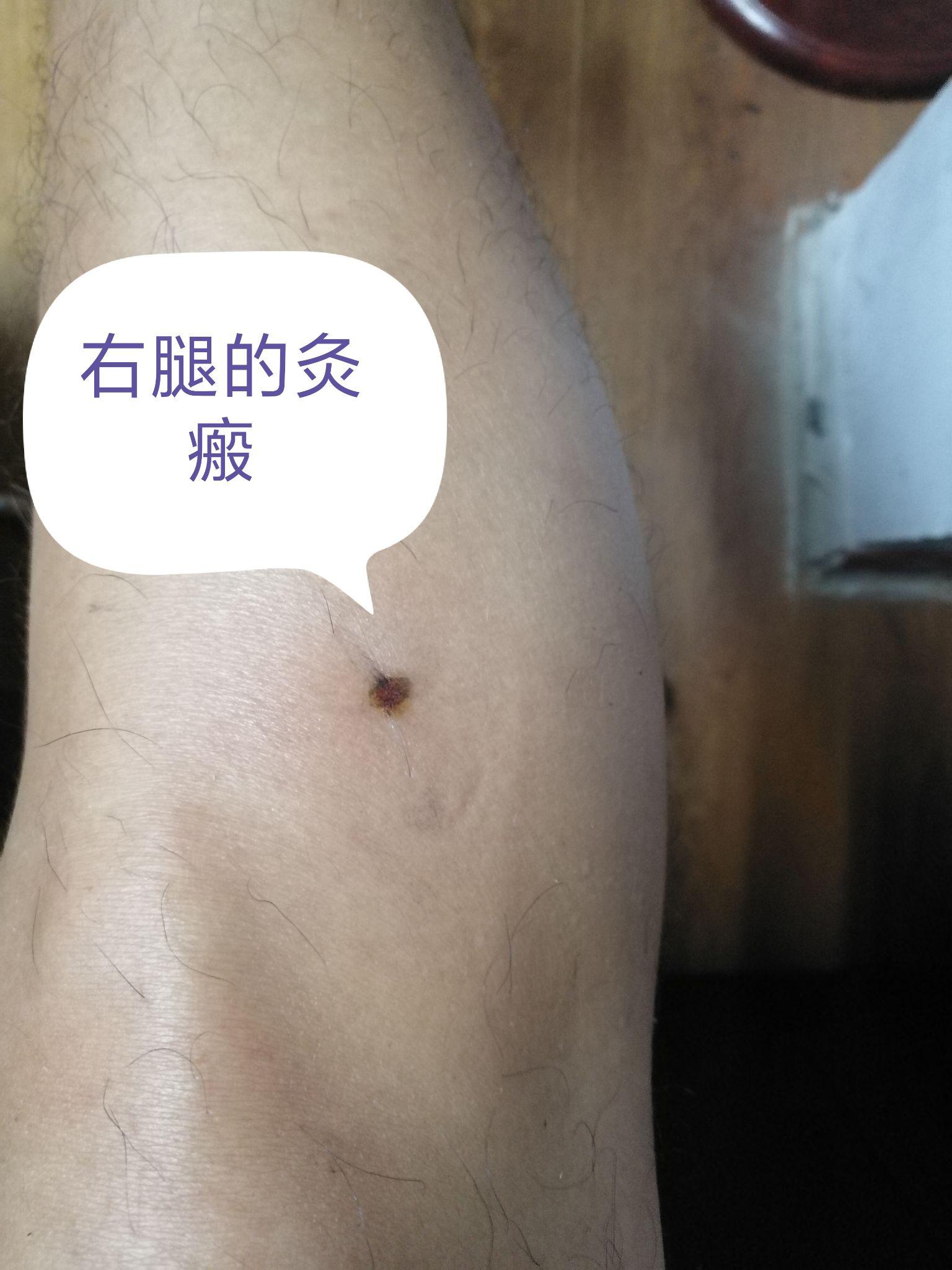 足三里瘢痕灸酸爽得不得了