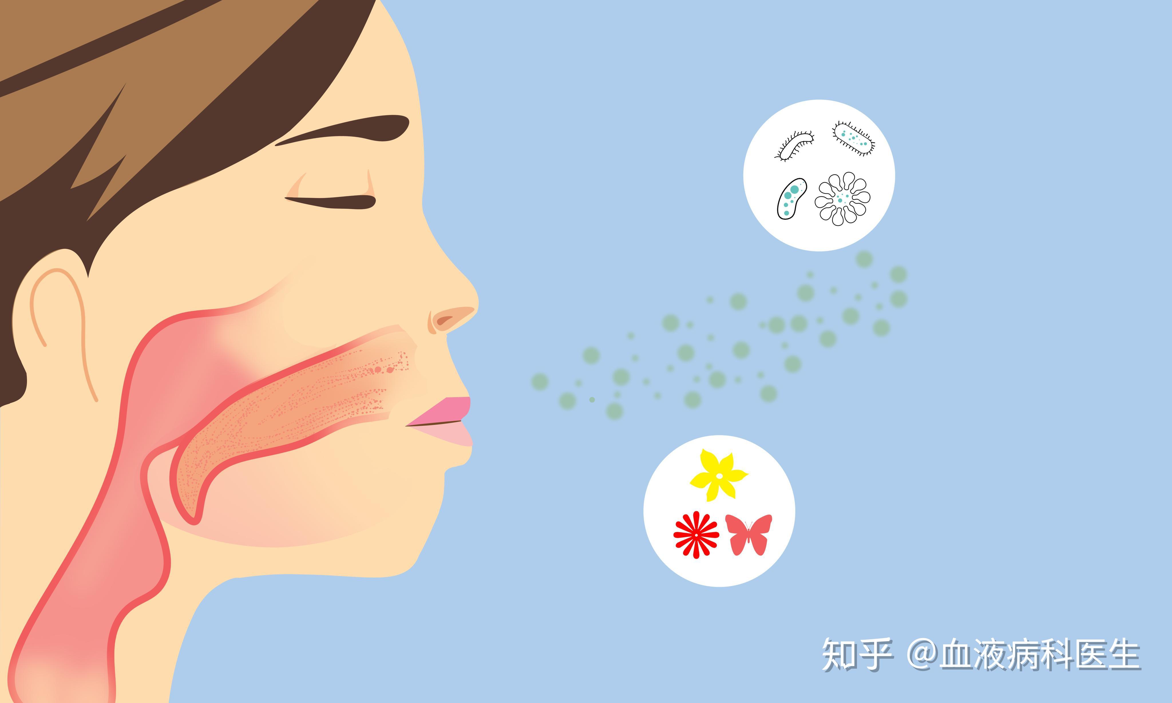 春季过敏性鼻炎高发，教您如何防治 - 知乎