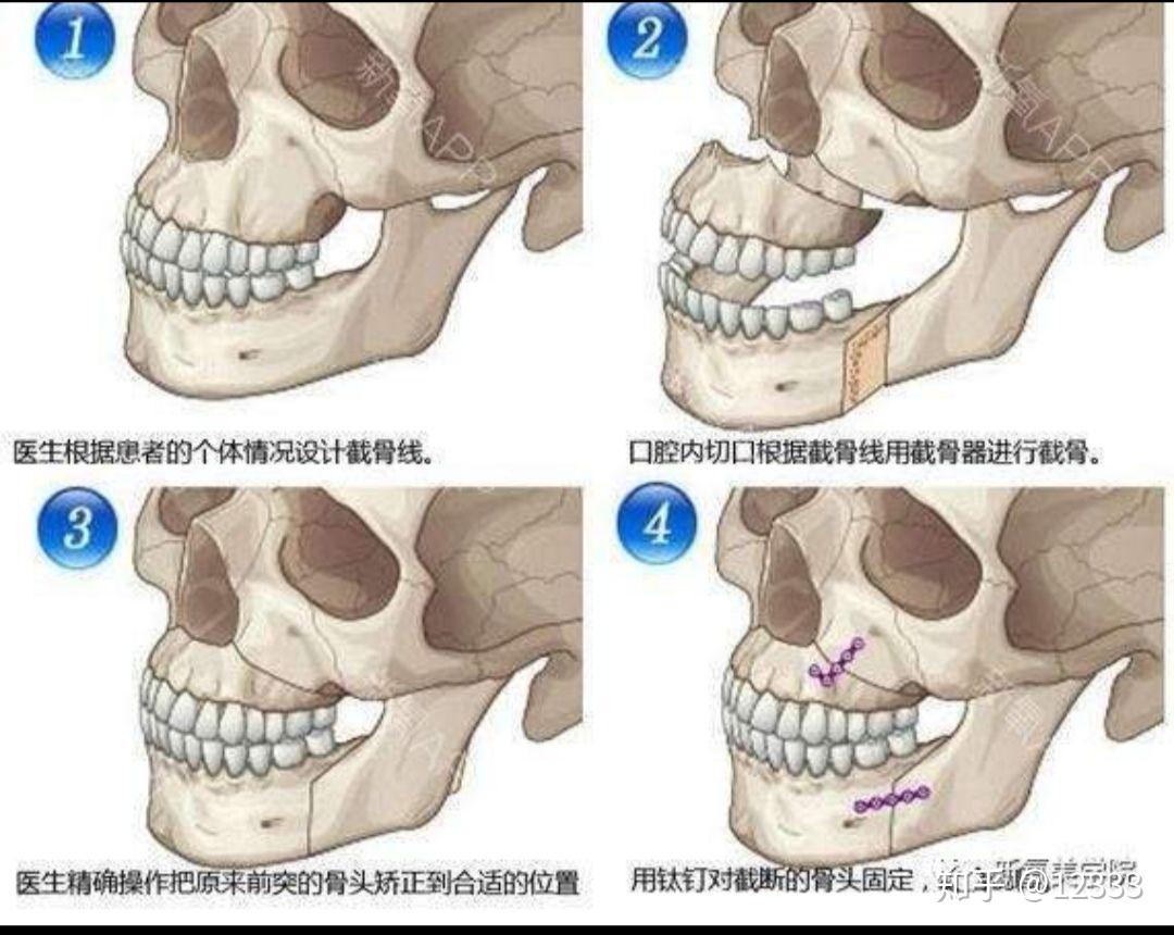 图32 下颌骨-人体解剖组织学-医学
