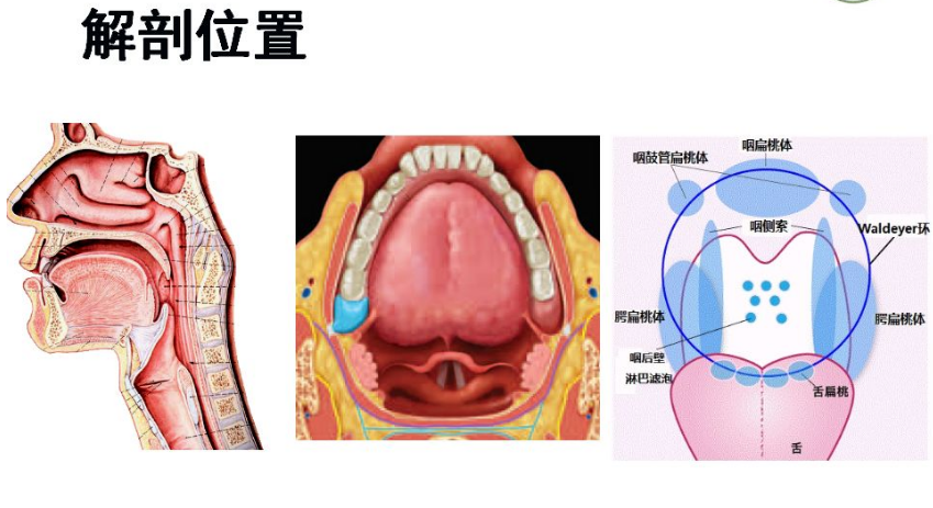 腭舌弓和腭咽弓位置图图片