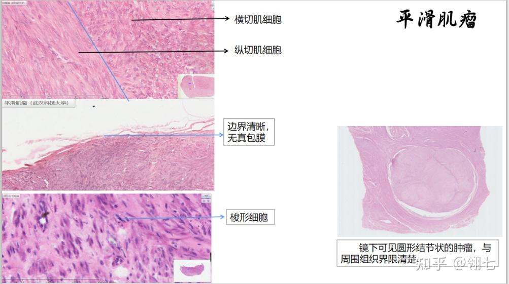 瘤组织由纵横交织呈束状排列的梭形细胞组成,瘤细胞与正常平滑肌细胞