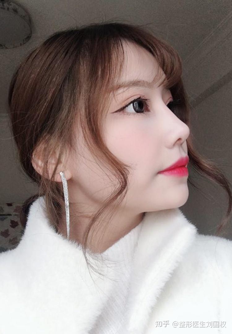 自己的气质比较接地气,但手术后五官洋气了很多,鼻尖的弧度自然流畅