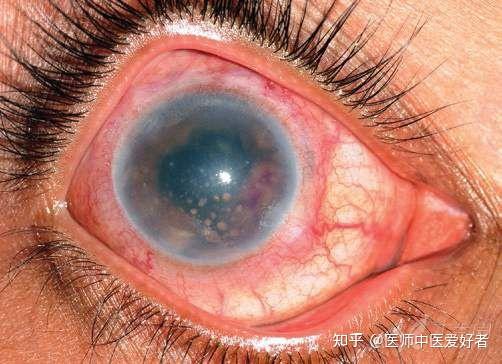 眼结核可引起复发性结节性巩膜外层炎,巩膜炎,角巩膜炎和角巩膜葡萄膜