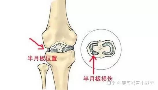 求推荐户外骑行护膝半月板2级损伤