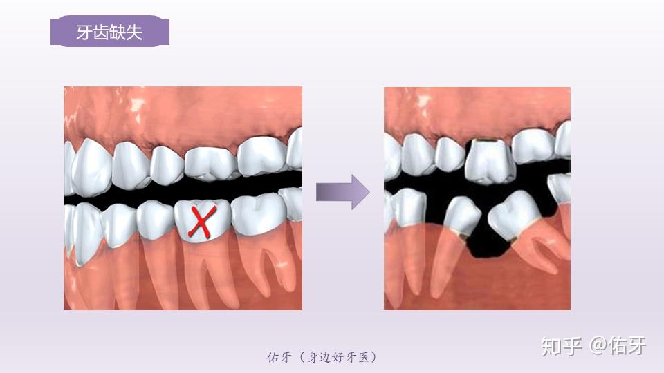 造成恶性循坏;缺牙间隙对颌的牙齿因为缺少对颌牙的压力,会出现伸长