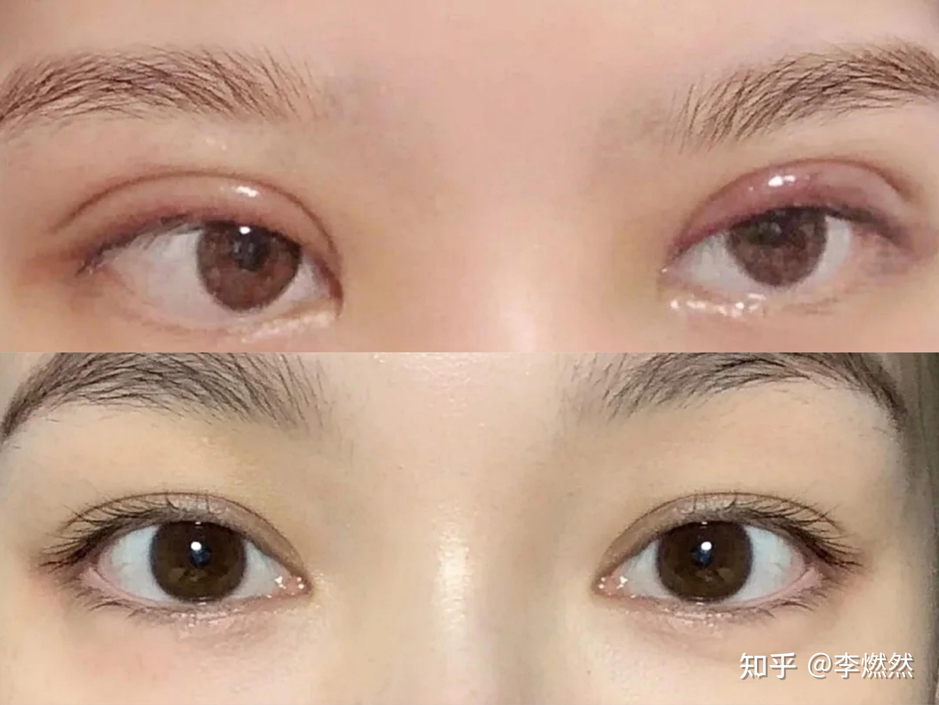 很多人双眼皮做的显假,不是因为眼皮做的过宽,也不是因为肉条明显