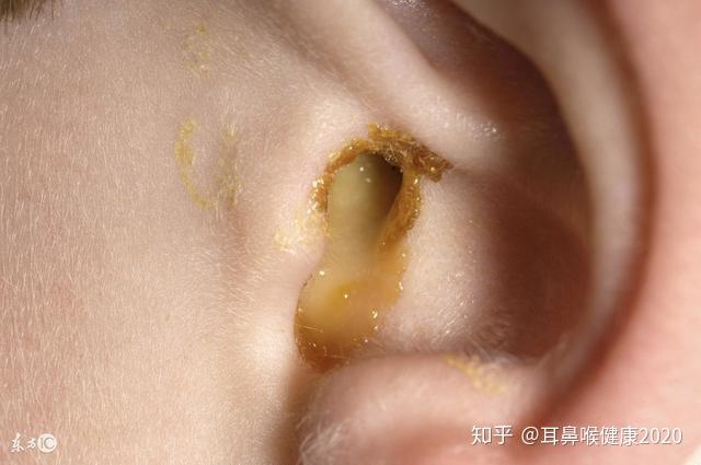 3,有些患者在平时的时候,挖耳时不慎损伤外耳道皮