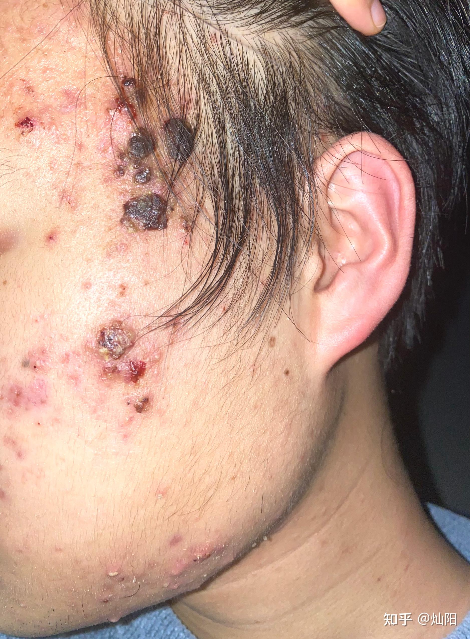 分别是异维a酸软胶囊(泰尔丝),克林霉素甲硝唑搽剂,过氧苯甲酰凝胶