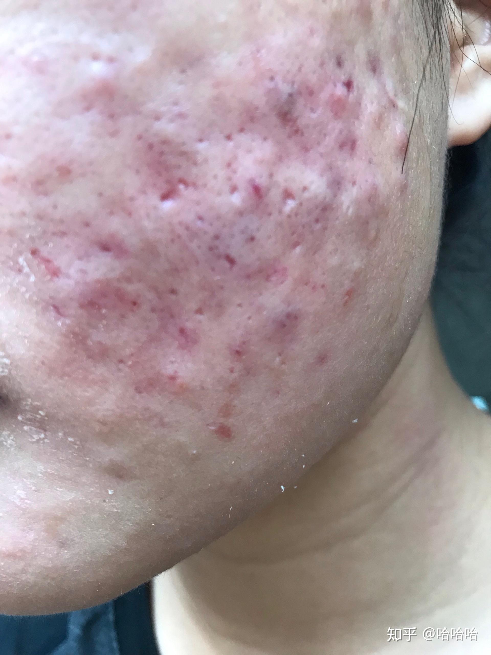 但是却在里面,没想出来,现在,脸部已经没有了,这个就是我的治疗痤疮