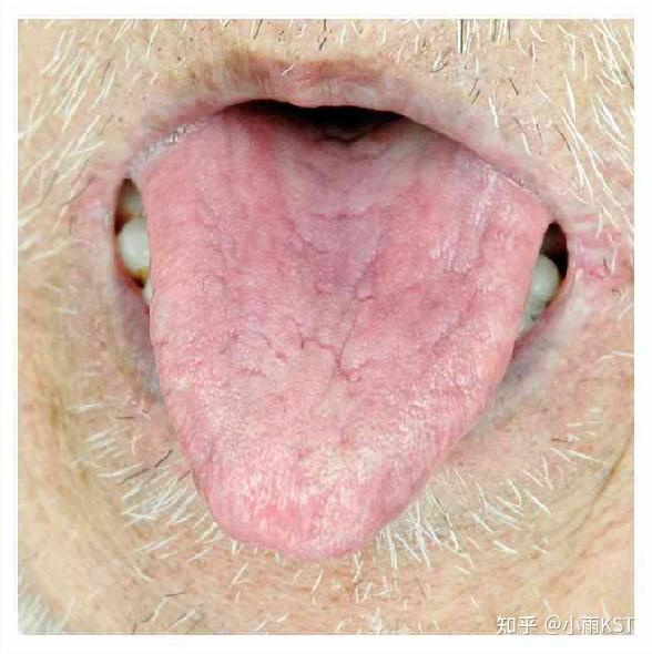 是对舌象特征的综合判断,以"红活"作为辨别要点,主要表现为舌质的荣枯