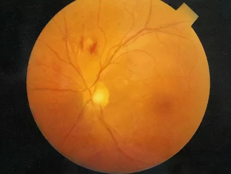 哪些人易患青光眼 - 知乎