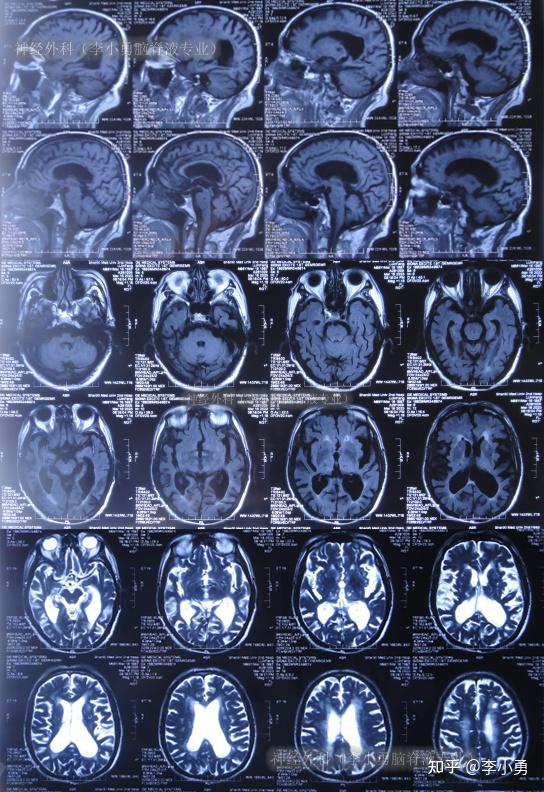 81岁老年脑积水腰大池分流术反致颅内感染颅内出血及走路不能2年余