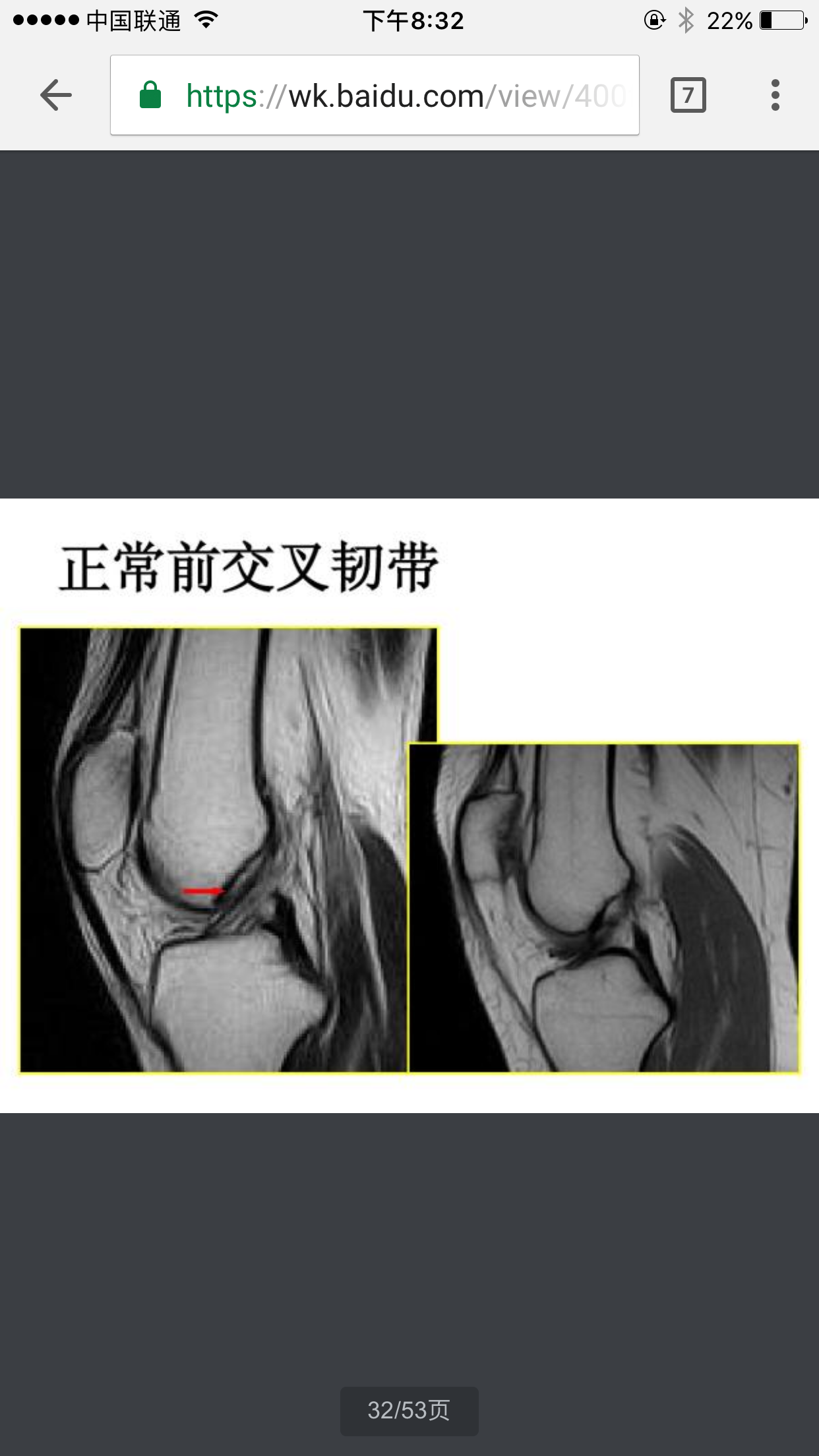 你是怎么知道自己前叉韧带断了的? - 知乎