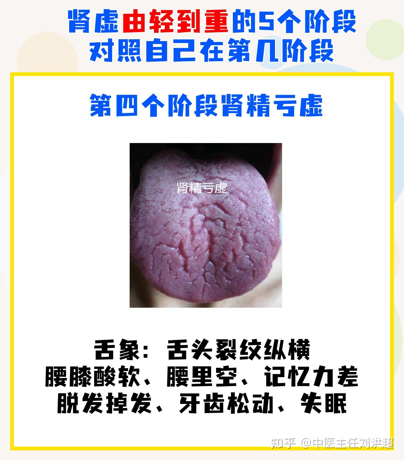 肾虚共有5个发展阶段,舌象及对应表现,对照自己发展到哪一步? - 知乎