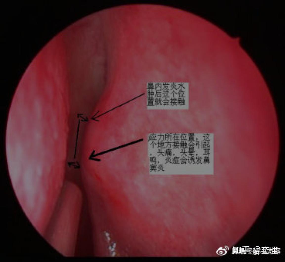 (二)鼻涕倒流原理和手术治疗经过