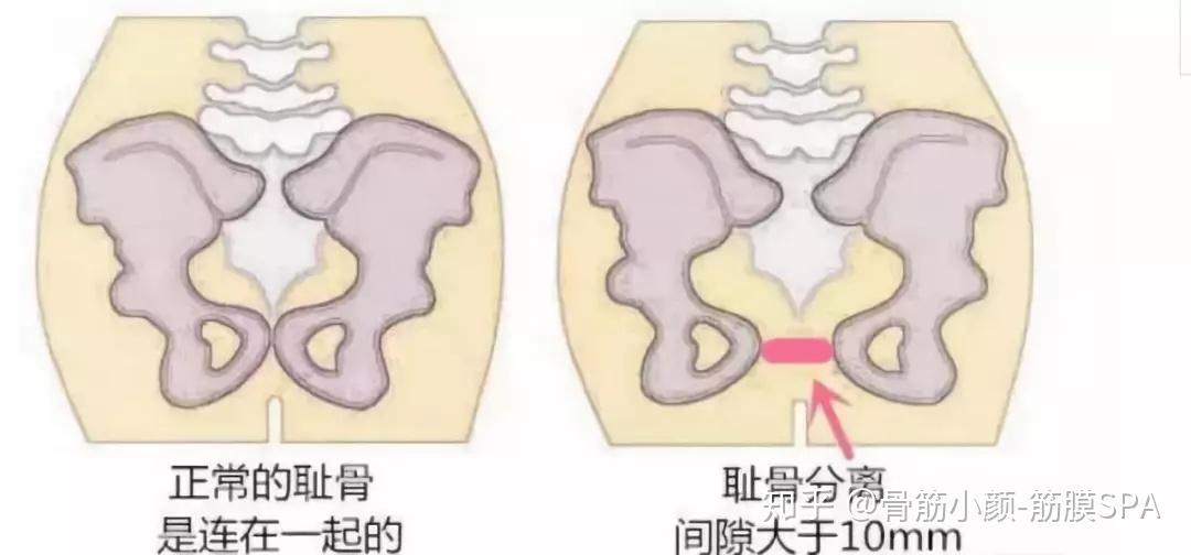 耻骨联合矢状面图片