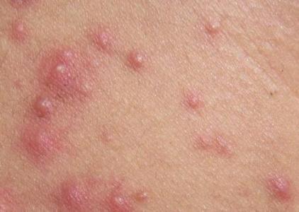 粉刺丘疹脓包快来测测你的痘痘属于什么类型