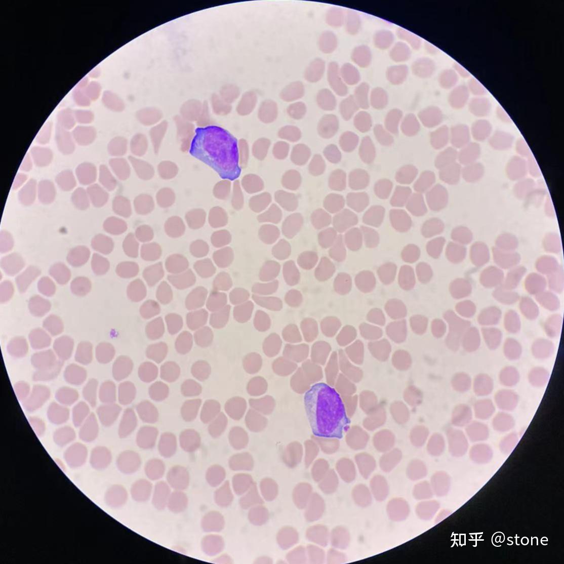 异型淋巴细胞/反应性淋巴细胞