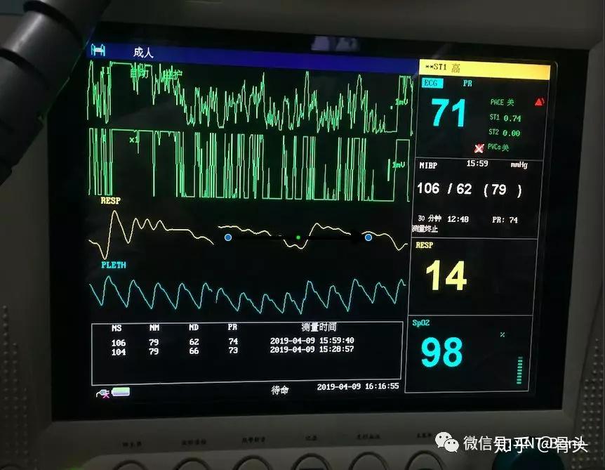 心电监护仪怎么看波形图片