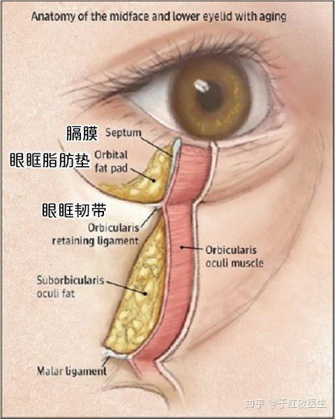 脂肪萎缩:眼部脂肪有三层,包含皮下脂肪,眼轮匝肌下脂肪,眼眶内脂肪