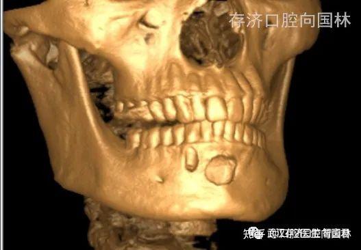 典型案例超聲骨刀下頜骨囊腫摘除根尖切除根管倒充填術