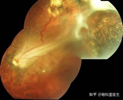 眼弓蛔虫病(ocular toxocariasis)