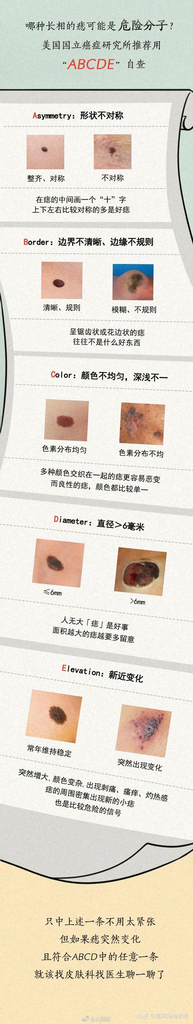 鉴别普通痣和黑色素瘤的区别 676767