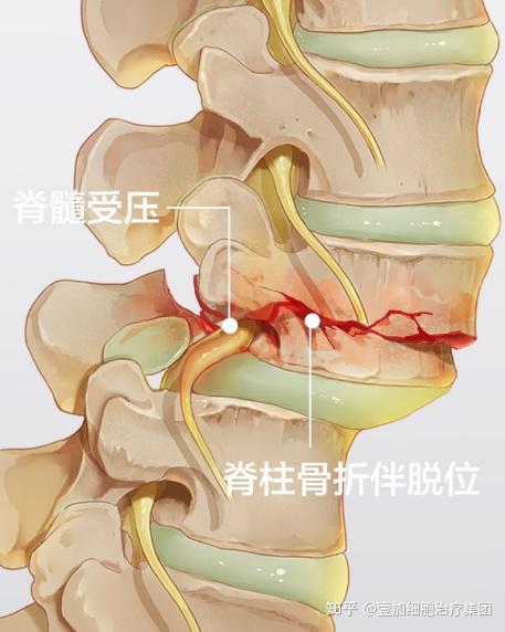 脊髓损伤分布图图片