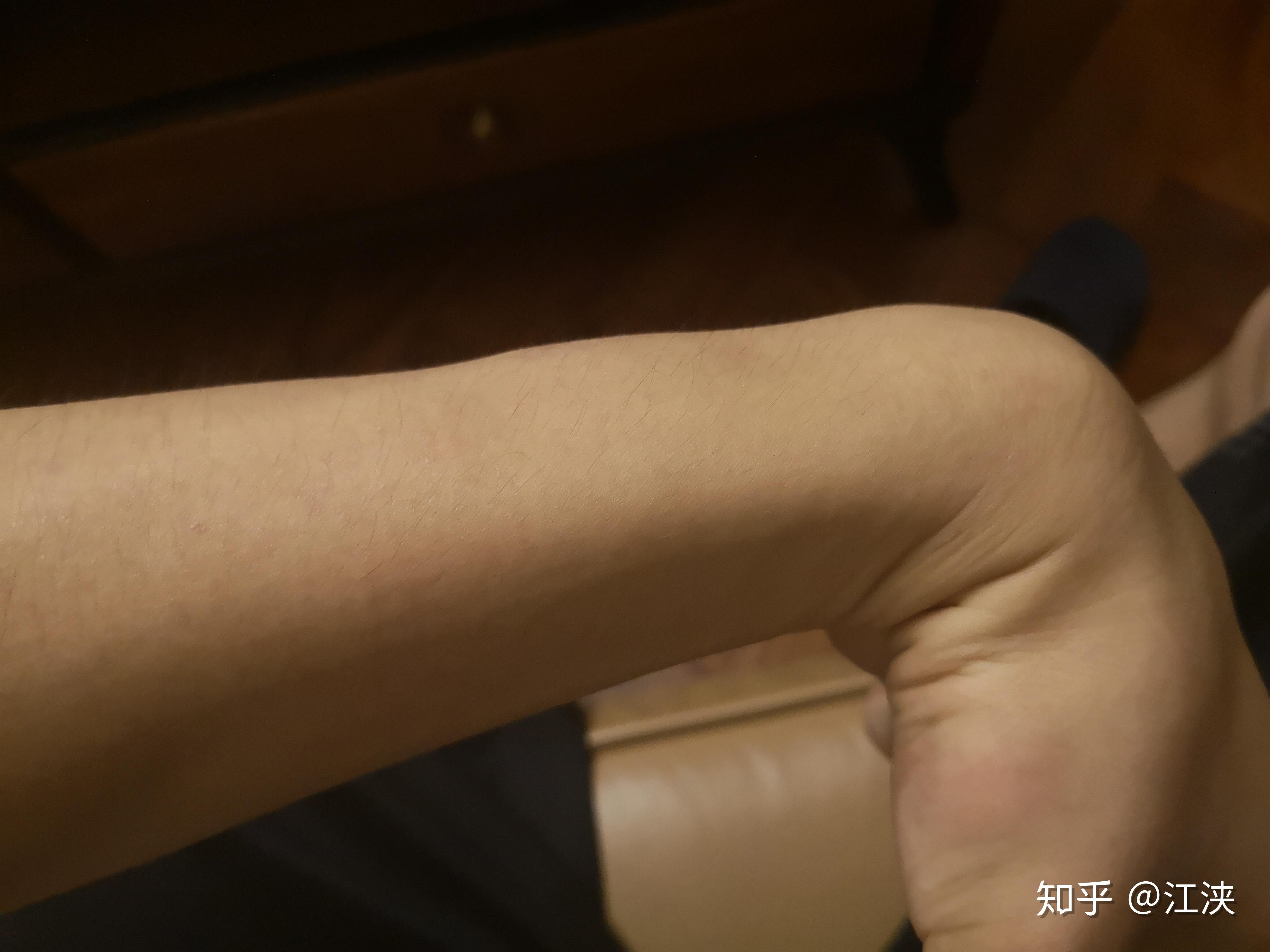 表现(中间有个鼓起来的部位)鼠标手和肌肉劳损这类病也没什么治疗方法