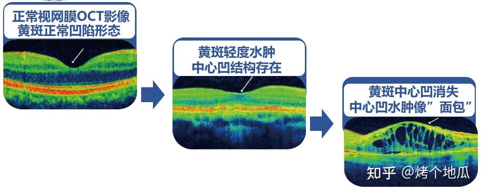 糖尿病視網膜病變伴黃斑水腫,奪走視力的無聲