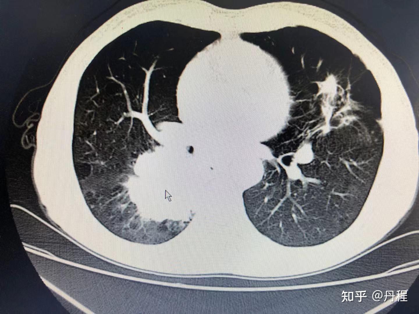 肺腺癌图片 晚期图片