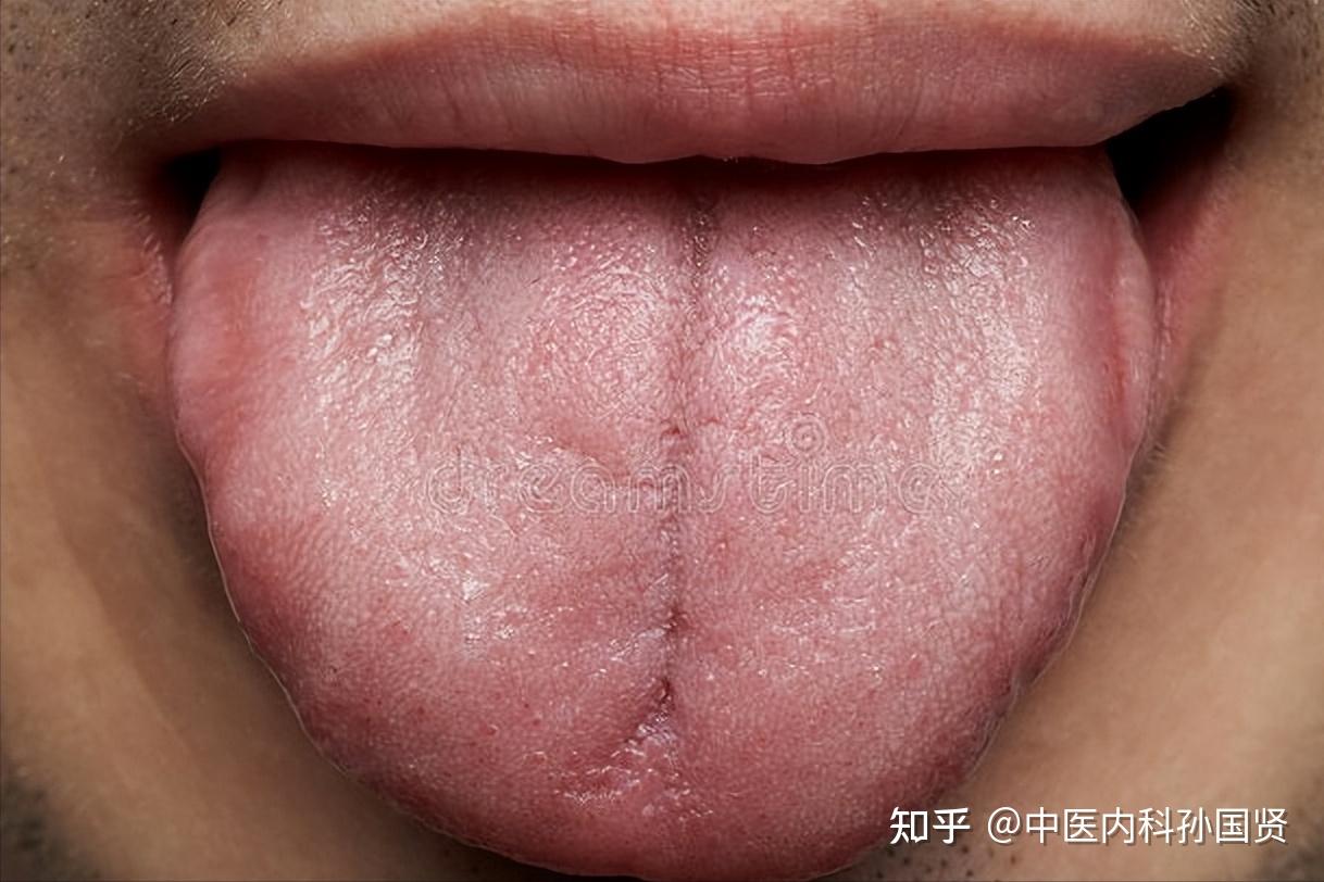 健不健康看舌头就知道？舌头出现这7种现象，可能是身体发出疾病预警 - 知乎