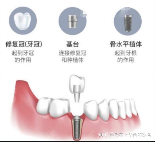 【大揭秘】支撑种植牙的“房梁”——基台是如何稳固牙冠的? - 知乎