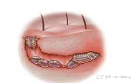 疥瘡結節裡面還有疥蟲嗎