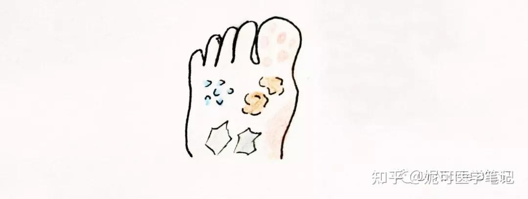 学习分享92脚气香港脚的自检及预防控制