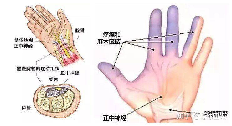 手腕腱鞘炎在哪个位置图片