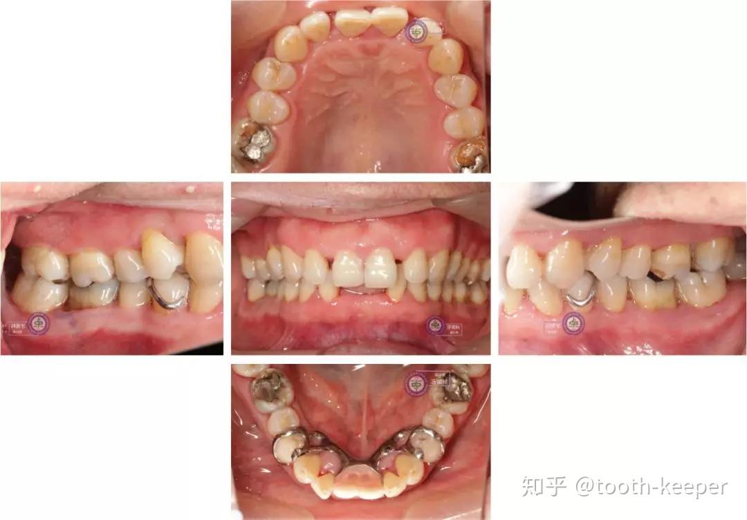药物性牙龈肥大序列治疗一例