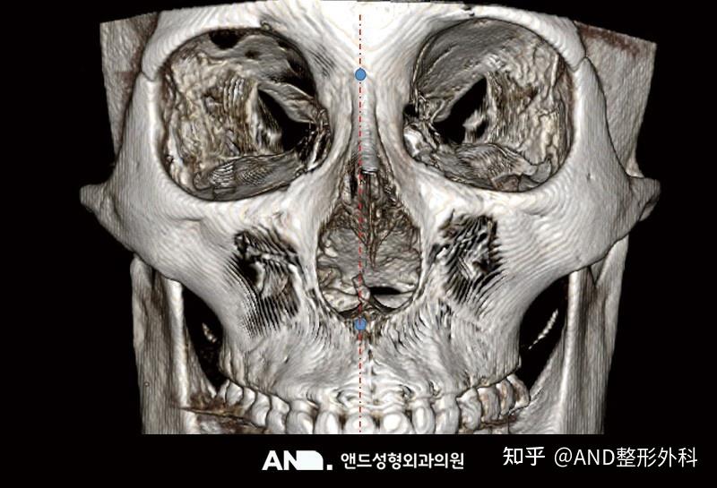 鼻骨三维ct图像图片