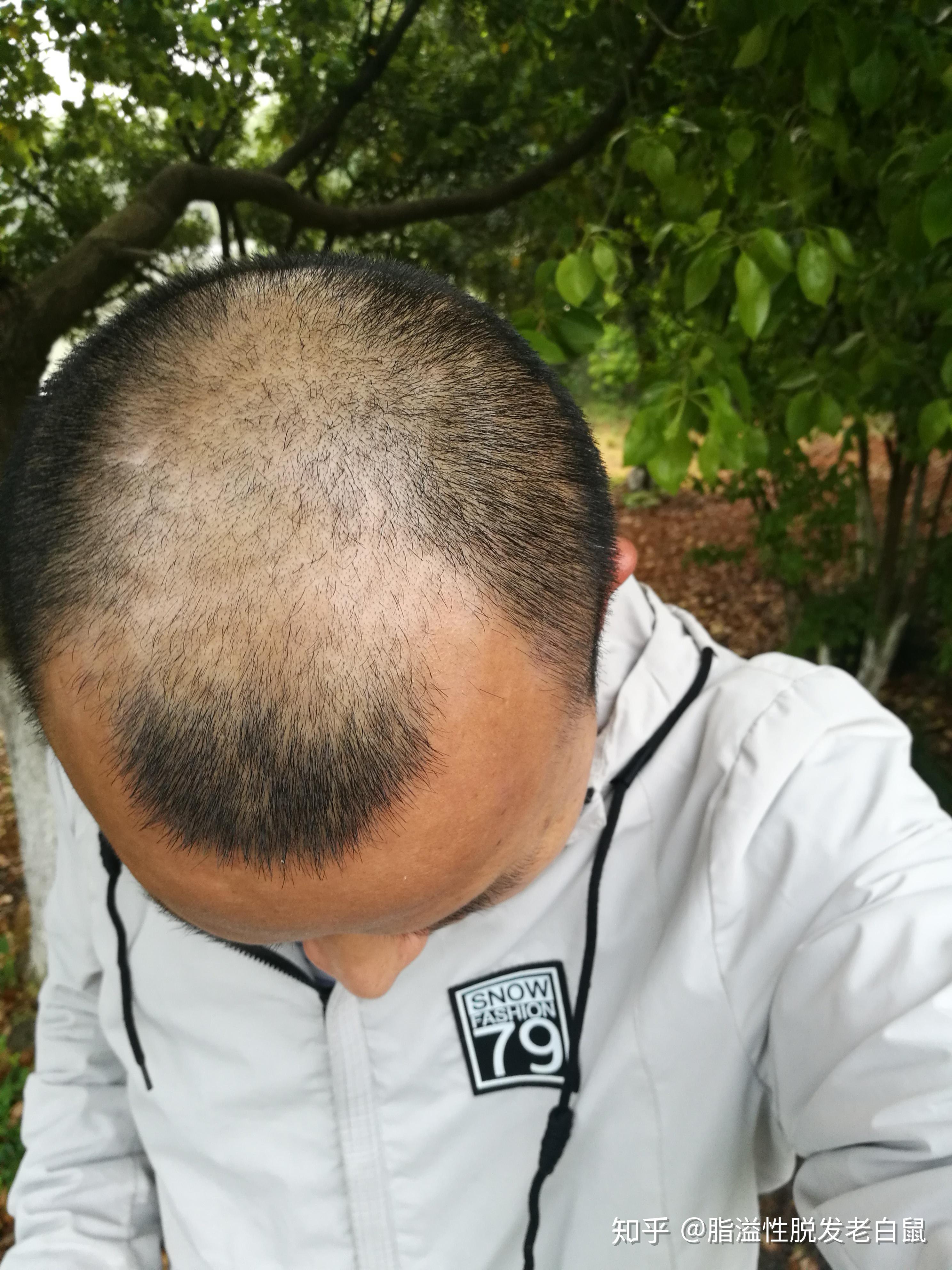 这是脱发的现象吗左边发际线明显比旁边高