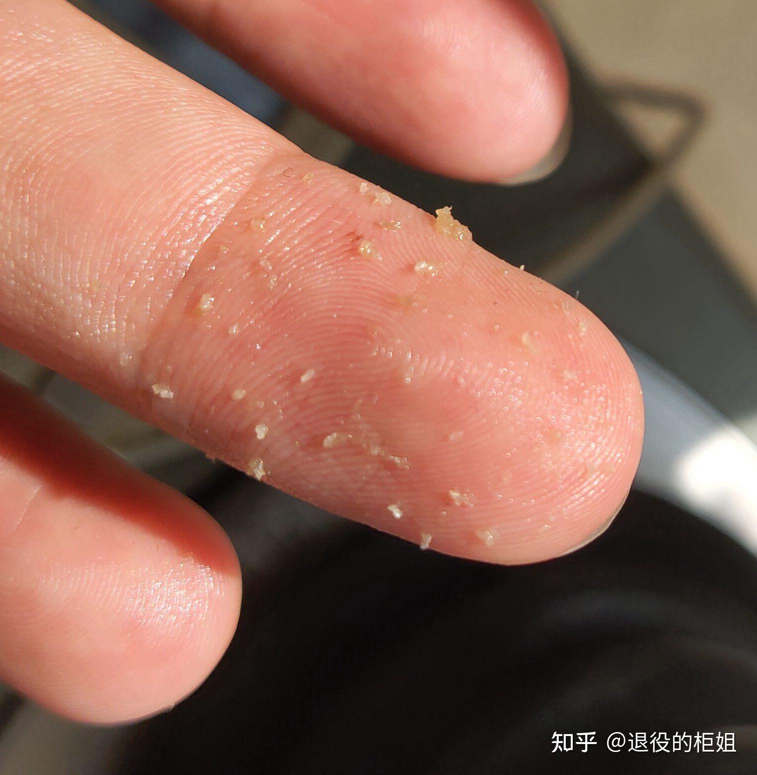 是"螨虫窝","闭口"什么的,也有人怀疑是酒糟鼻,其实都不是,就是黑头